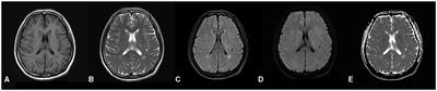 A Chinese patient with POLR3A-related leukodystrophy: a case report and literature review